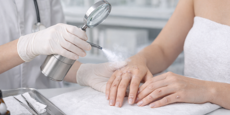 Как вывести бородавки