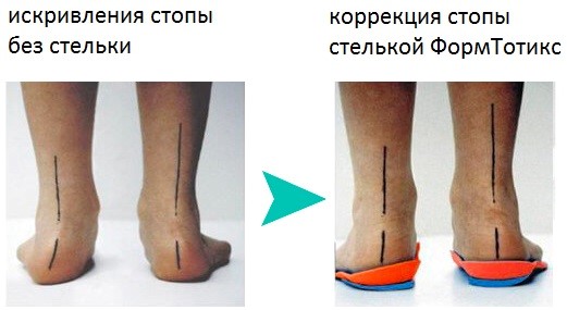 Коррекция стопы – фото на сайте Медицинского центра Доктора Амосовой, Алушта, Крым